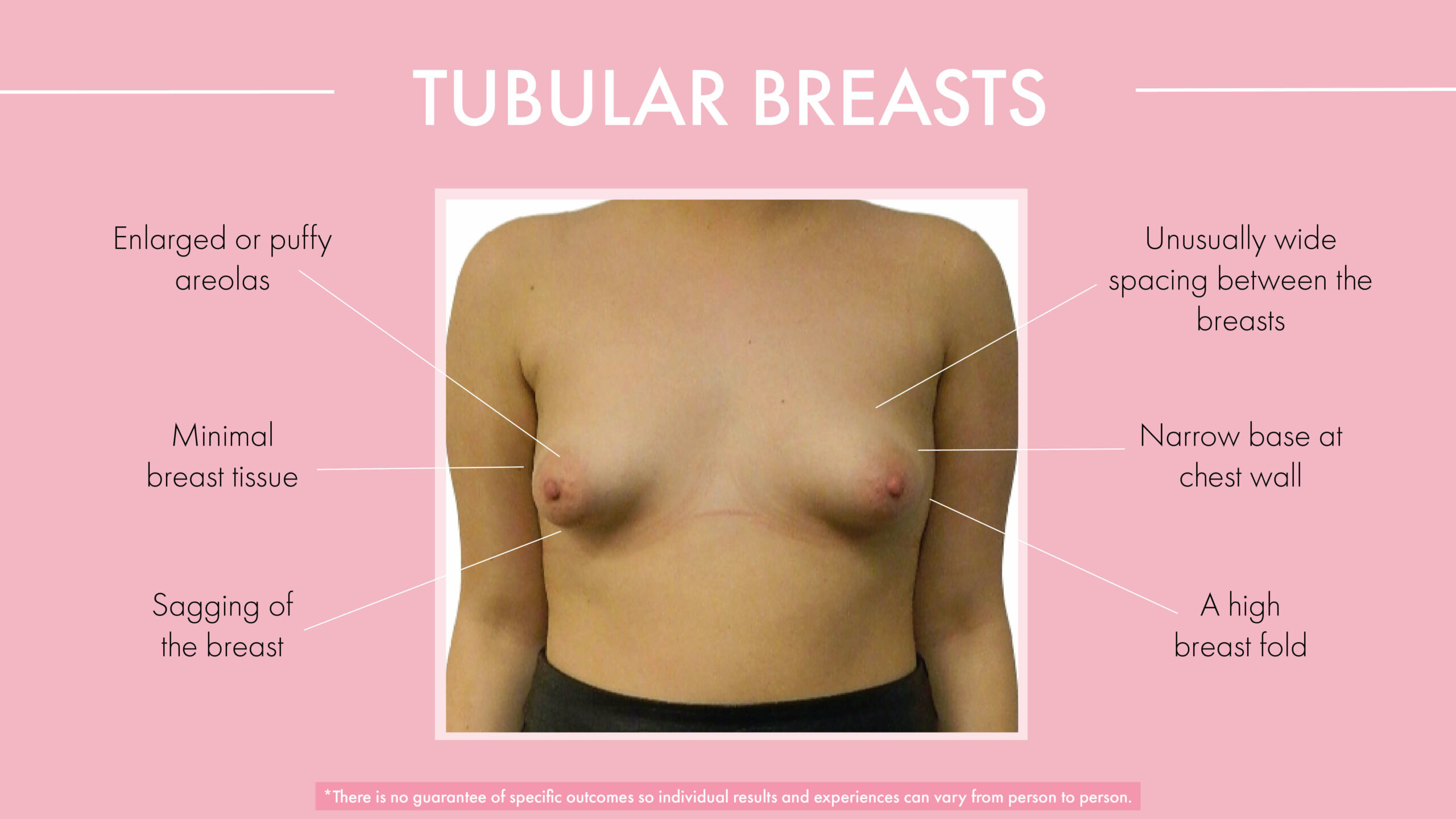 Tubular breast features and characteristics 