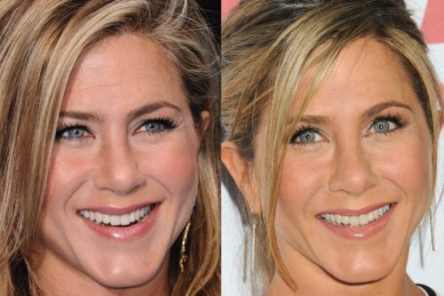 Has Jennifer Aniston Had Cosmetic Surgery