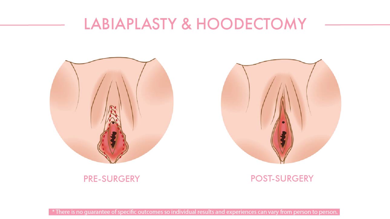 Post Op Vaginoplasty