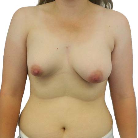 Breast enlargement before image 0