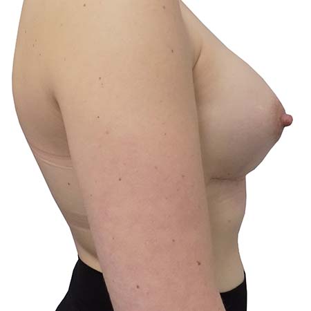 Breast enlargement after image 0