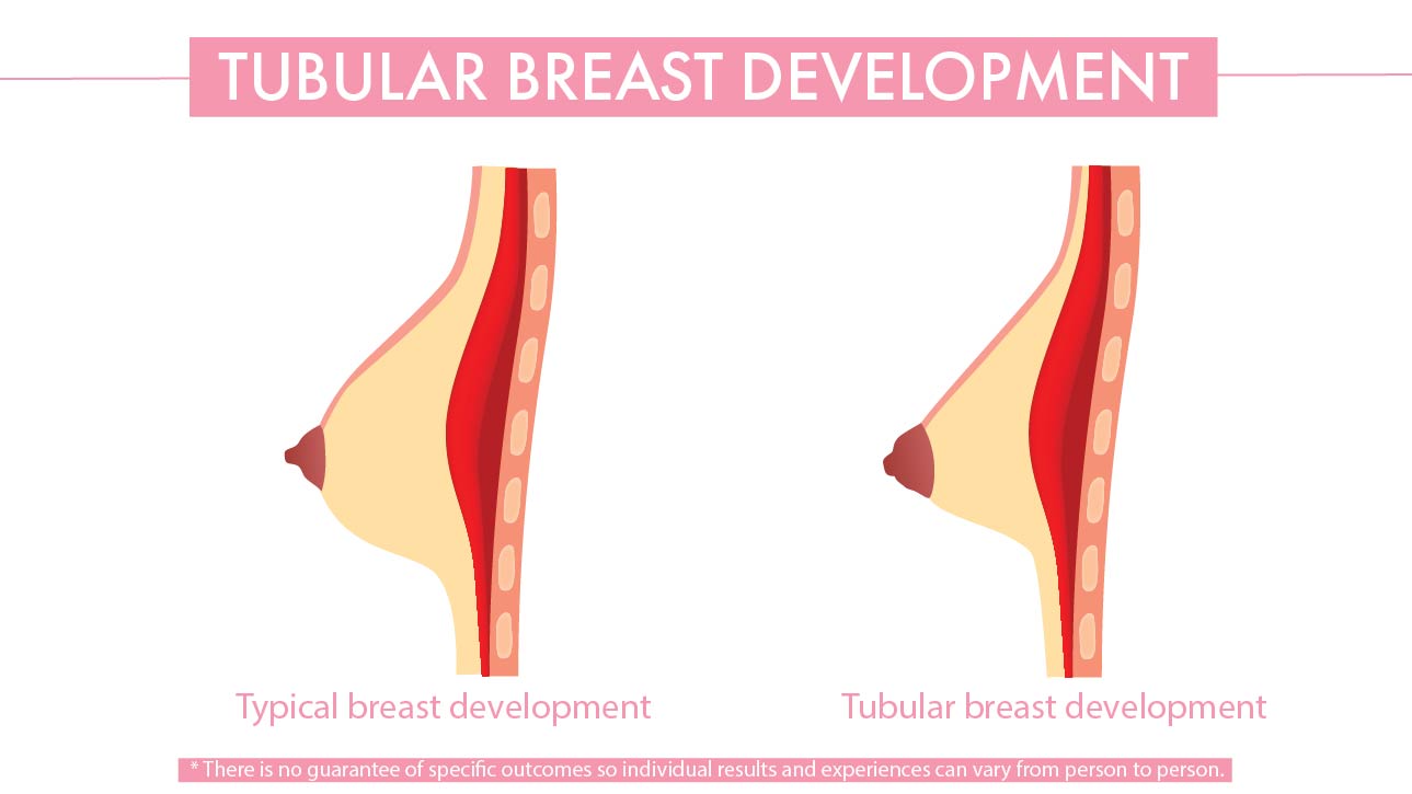 Tubular breast development diagram 