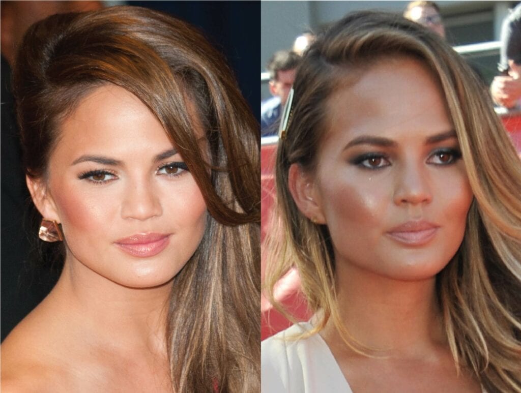 Has Chrissy Teigen had cosmetic surgery?