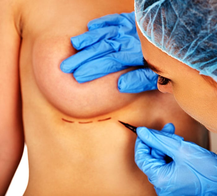 How long after breast augmentation can I…?
